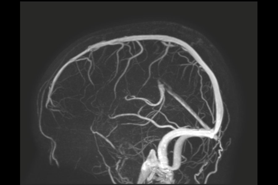 PCA (Phasenkontrast-Angiographie) der Kopf-/Halsgefäße