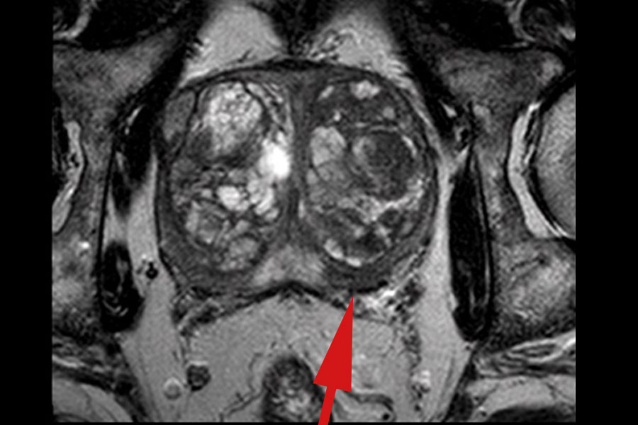 prostata mrt auswertung)